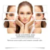 Acne Soothing Serum Facial Skin Hydration Moisturizing Acne Pit Pimple Gentle Care Solution